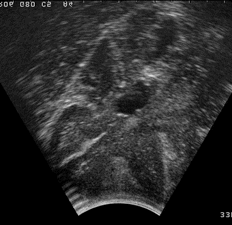 Echographie 3D
